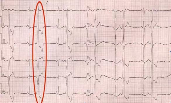 医生告诉你:发现室性早搏怎么办?_腾讯新闻