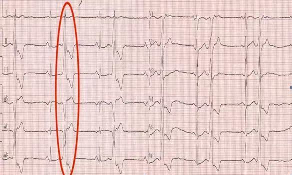 室上性早搏的心电图图片