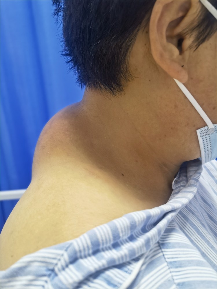 富贵包并不富贵原是巨大脂肪瘤