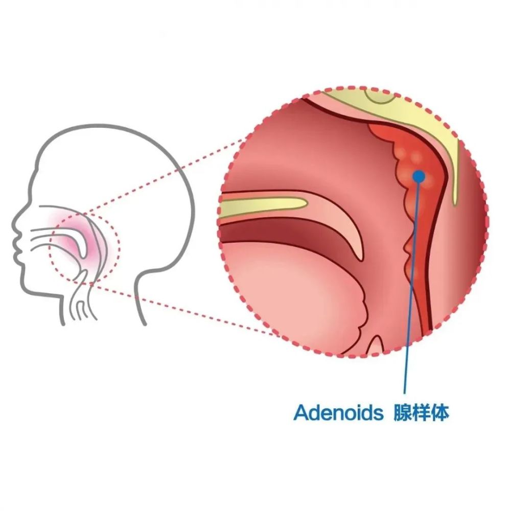 腺样体肥大手术价格成都民生耳鼻喉医院收费贵不贵国家三级医院