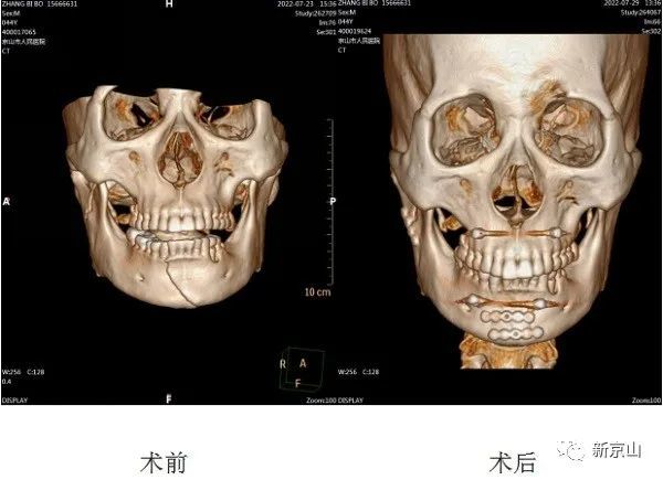 京山市人民醫院自主完成首例下頜骨髁突低位骨折經腮腺切開復位內固定