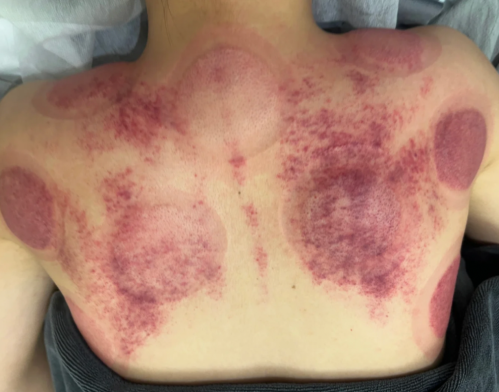 邢菲分享的刮痧照片十分真实,只见她简单盖着一条毛毯,背上红紫一片