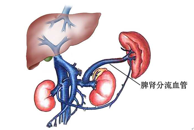 應首選warren手術治療(圖1),降低門靜脈壓力,控制食管胃底靜脈曲張