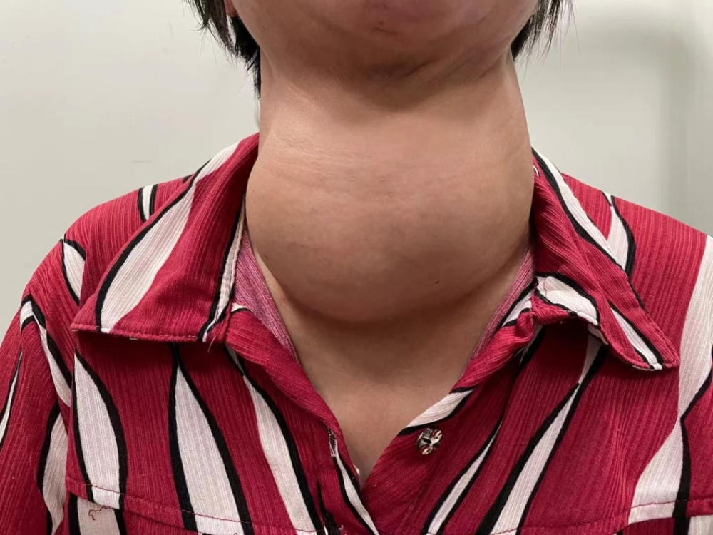 漳州女子脖子上长出14厘米大超级肿瘤医生提醒