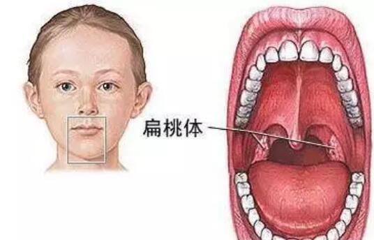 孩子扁桃體炎又犯了,到底切還是不切?