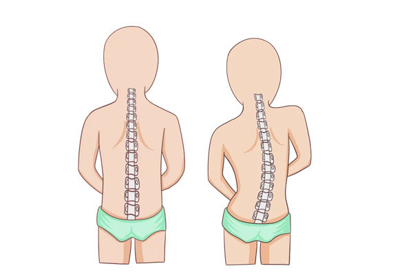 脊柱側彎患者能自愈嗎科學表明脊柱側彎沒有自愈性