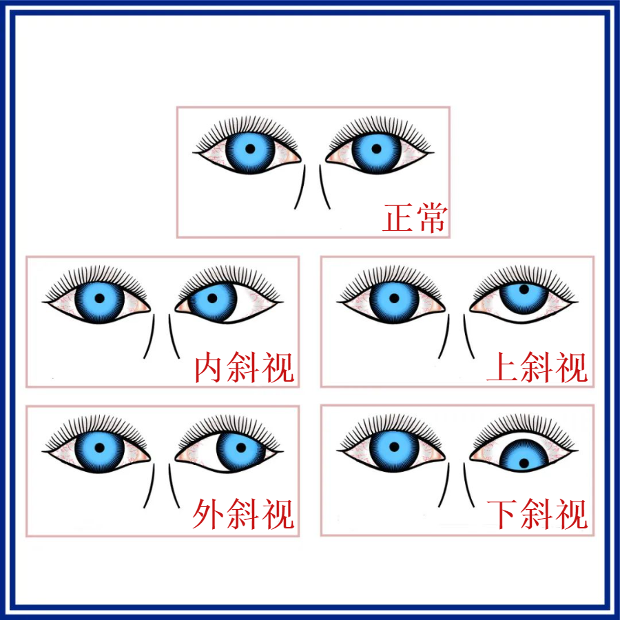 孩子患上斜視兩年蘇州九龍醫院專家支招治療