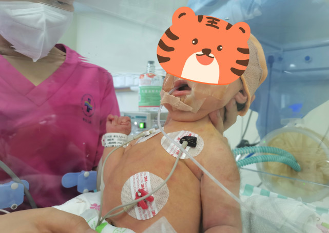 深圳一新生儿呼吸急促表情呆滞?医生诊断:罕见重症肌无力新生儿