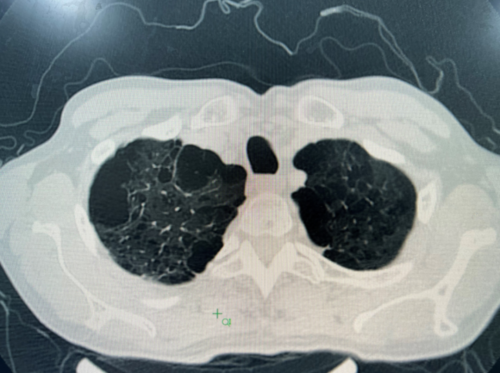 直播精华发现肺大泡还能进行吹气球等呼吸训练吗会不会导致肺大泡破裂