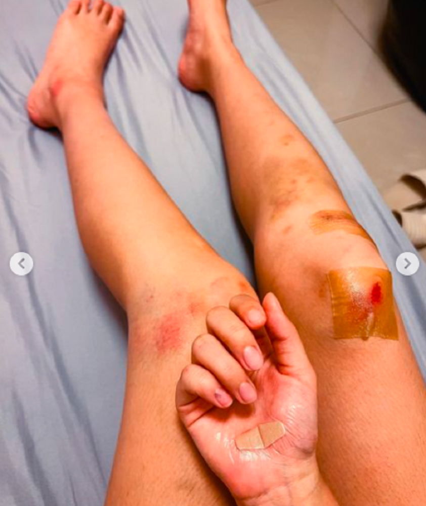 杨淨宇受伤最严重的地方就是双腿,原本白嫩纤细的美腿上满是淤青,多处