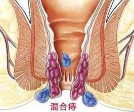 广州东大肛肠医院可信吗小小痔疮不切掉又会怎么样