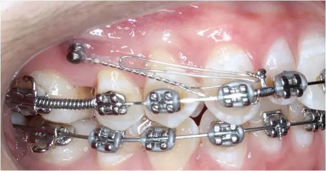 隐形矫正支抗钉照片图片