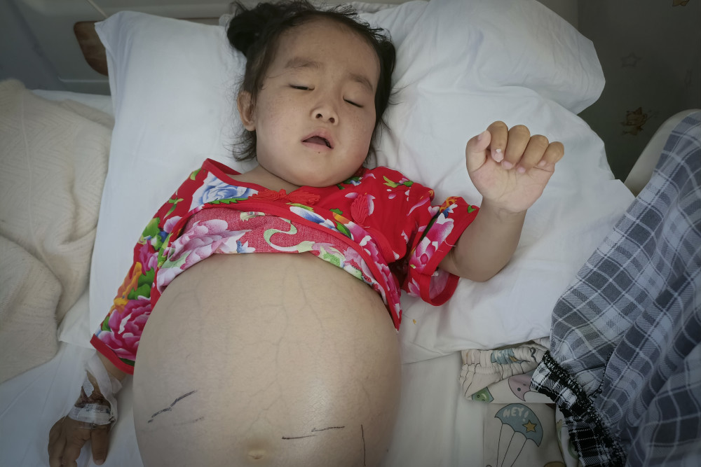 4岁女孩患重症肚子大如孕妇,被小朋友误会后痛哭:我不要生宝宝_腾讯