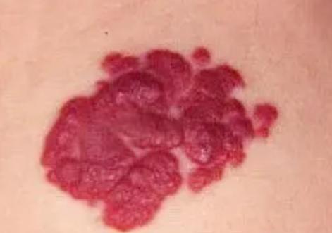 身上出现密密麻麻的小红点,不痛不痒是怎么回事?_腾讯新闻