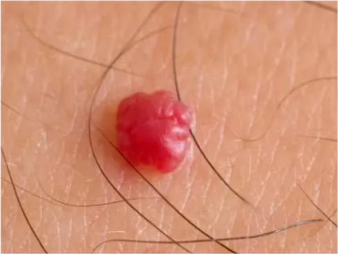 身上出现密密麻麻的小红点,不痛不痒是怎么回事?_腾讯新闻