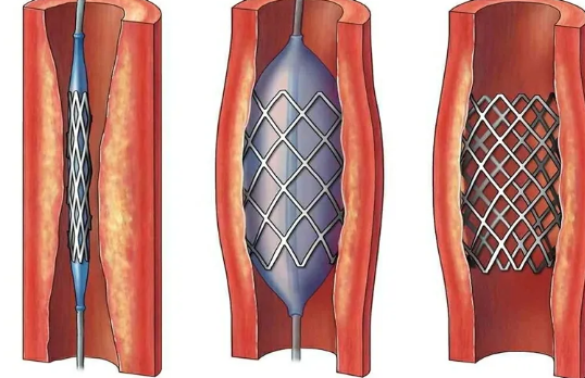 颈动脉狭窄患者的福音之颈动脉支架成形术