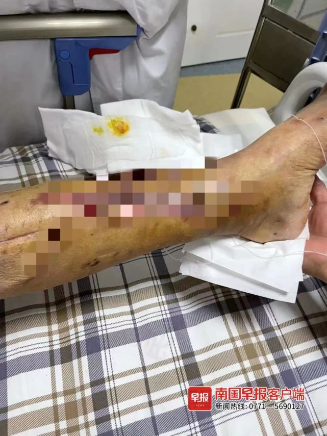 老人在斑马线上被网约车撞伤,动了7次手术!平台要不要赔偿?