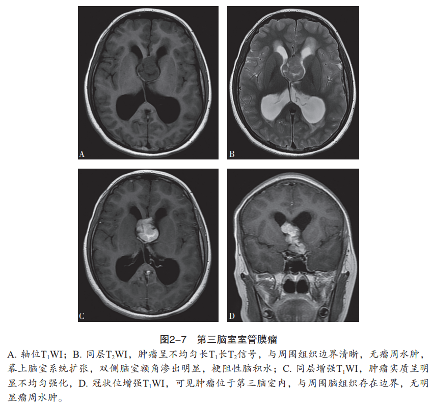 室管膜肿瘤的mri特点有哪些人卫书摘