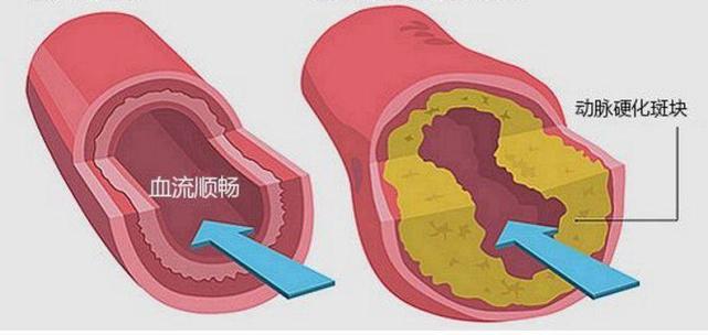 預防動脈粥樣硬化要做好這3件事!