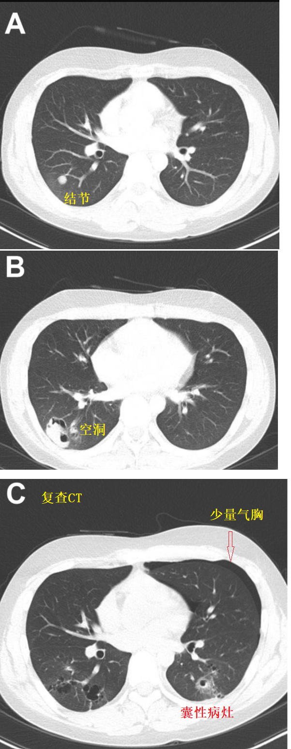 胸部ct:咯血時ct顯示結節,空洞(下圖a和b);發生氣胸時ct顯示一部分