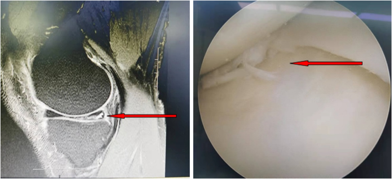 圖3膝關節半月板的損傷圖4膝關節鏡下見半月板損傷卡在關節內三,慢性