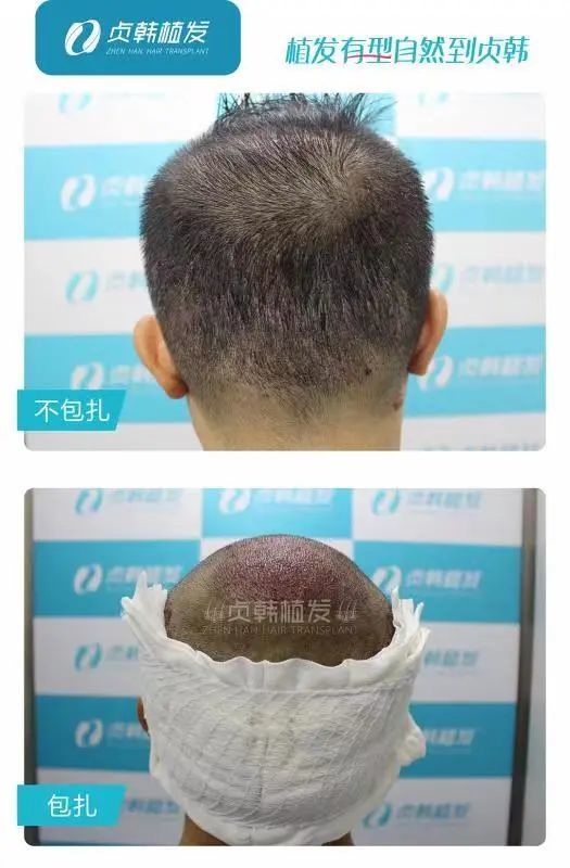 头顶植发杭州(杭州植头发要多少钱)