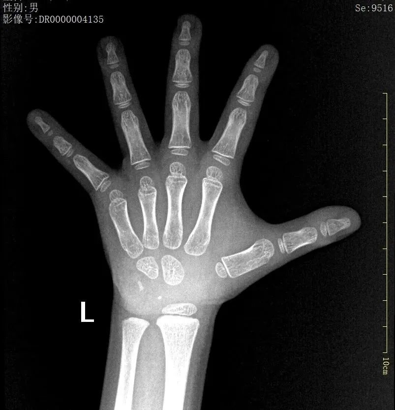 图1,左手正位x片一般是通过拍摄非利手(多为左手)腕部的x线片,观察指