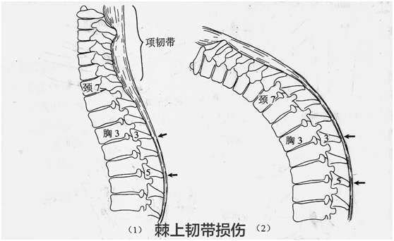 棘上韧带上起自第七颈椎棘突,下至于骶中嵴,向上移行上项韧带,外侧与