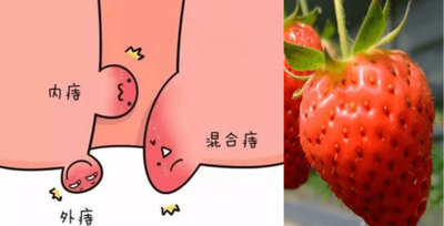 温水坐浴烧盆开水,让水蒸气先蒸蒸痔核的部位,然后当水温差不多在40度