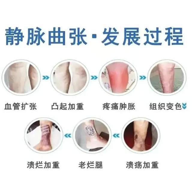 别忽视腿上的蚯蚓静脉曲张严重可致命教你怎么甩掉它