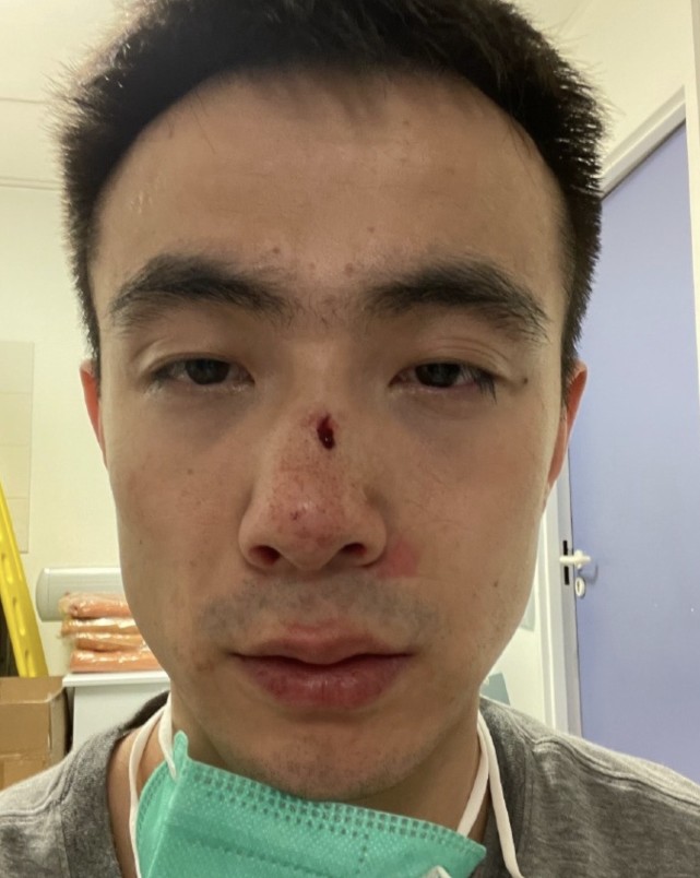 赵继伟晒鼻子受伤照谁还不是个精神小伙了