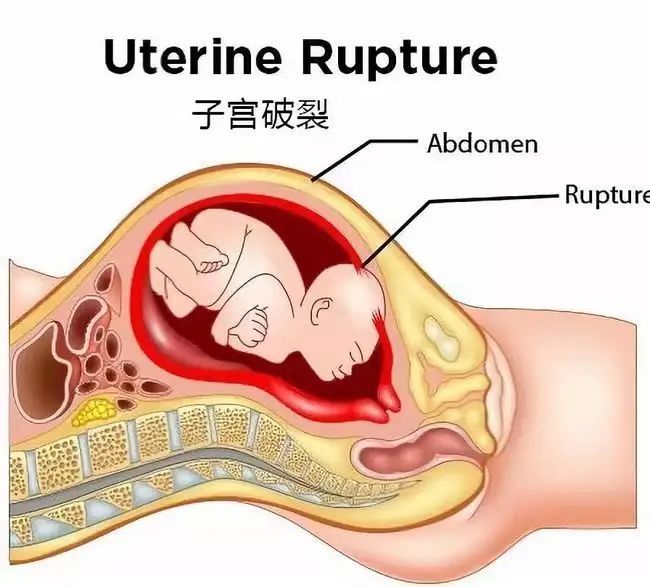 生死5小时三胎孕妈大出血2000毫升鬼门关前拉回命