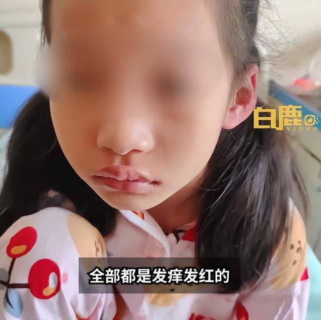太意外因为吃了这种零食女童输液头孢过敏浑身红肿