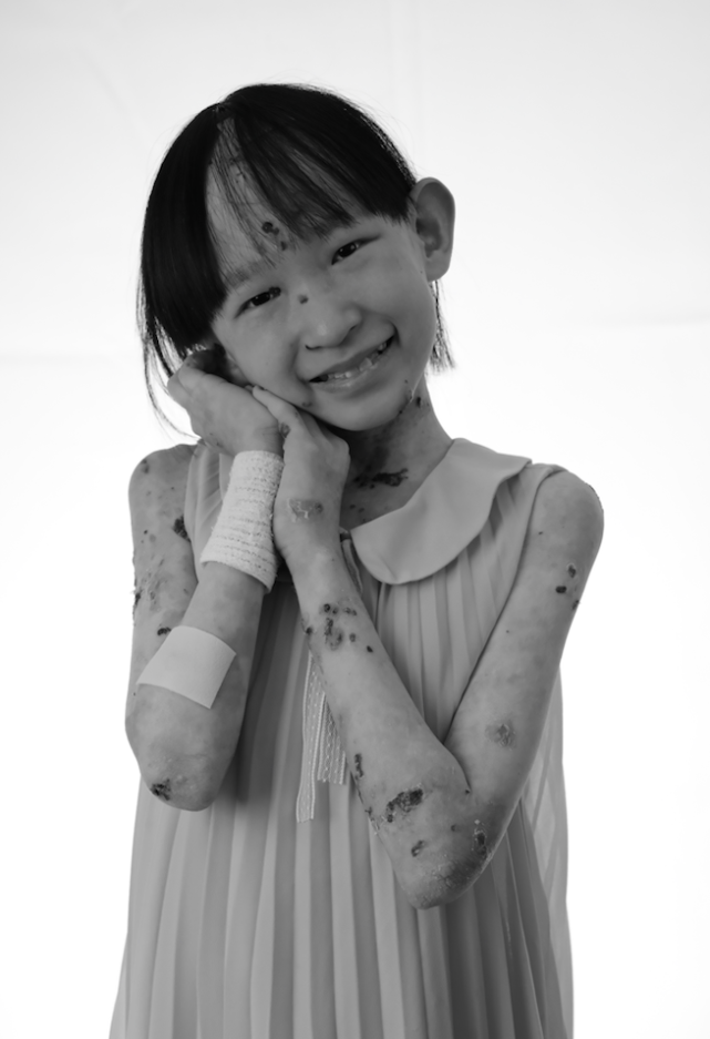 "蝴蝶宝贝"高歆一茸在出生时即被诊断为大疱性表皮松解症,2014年经