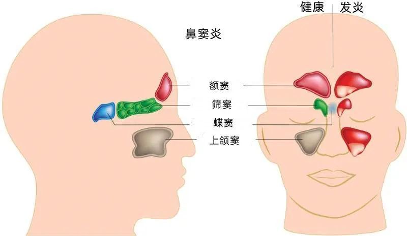 鼻竇炎是鼻竇的炎症,是普通鼻炎的炎症從鼻腔一直蔓延到鼻竇的位置了.