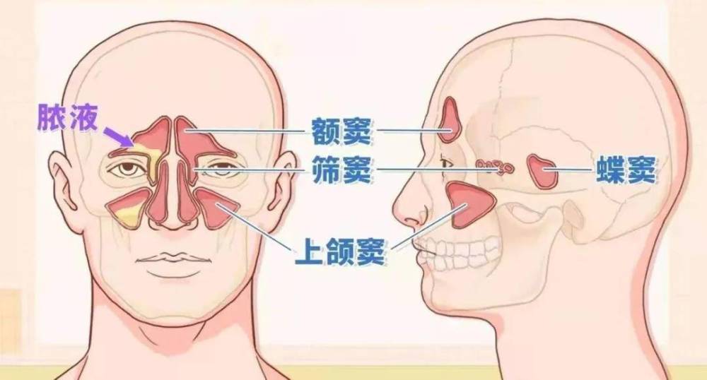 鼻窦炎不只是普通鼻炎家长千万别忽视