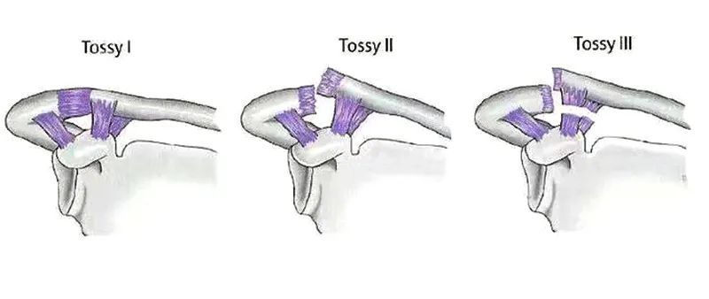 详细图示肩锁关节脱位的分型