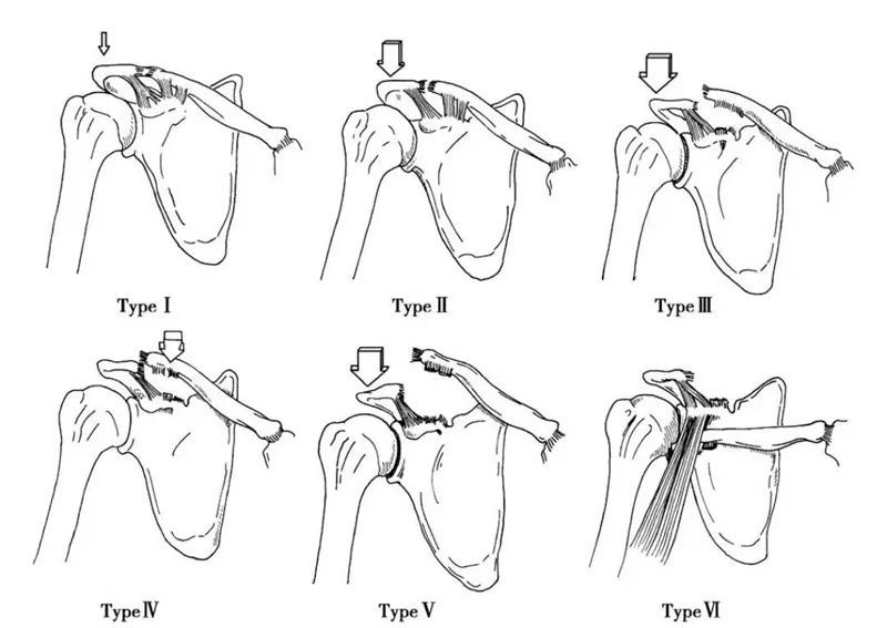 详细图示肩锁关节脱位的分型