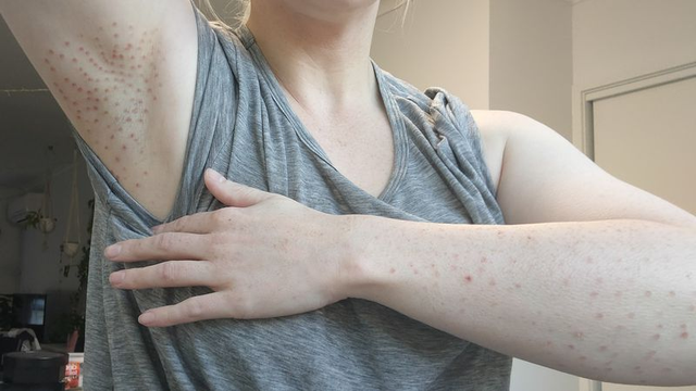 澳洲女子医美激光脱毛烧伤皮肤,有顾客留下永久性疤痕_腾讯新闻