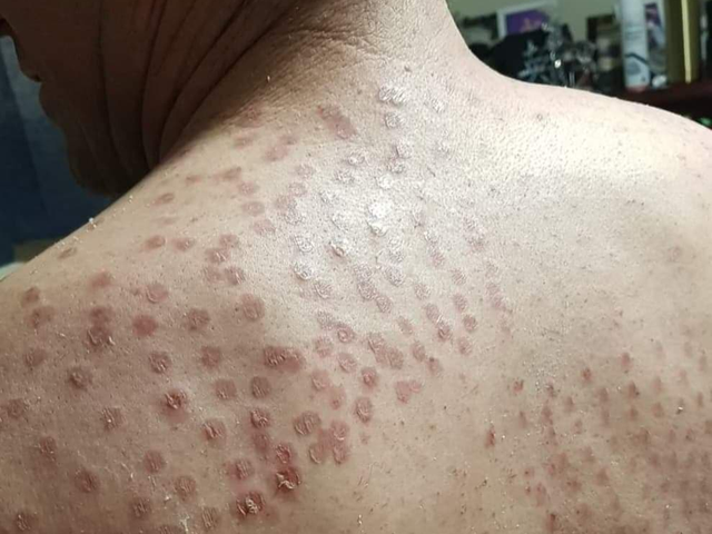 澳洲女子医美激光脱毛烧伤皮肤有顾客留下永久性疤痕