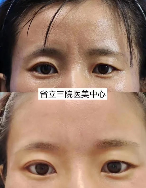 "苦大仇深"的眉间"川字纹"如何改善?