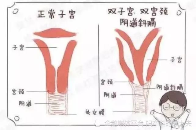 11岁女孩痛经哭闹不止查出2个子宫