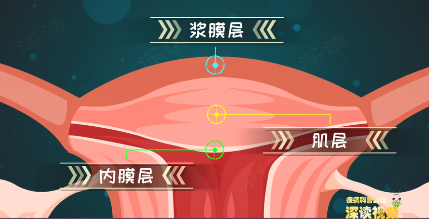 聚焦子宫壁,由内向外分别是内膜层,肌层和浆膜层,这三层都可能长肌瘤.