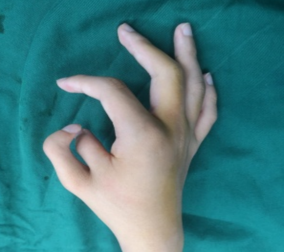 小伙天生六指,拇指形似"蟹钳"!医生巧施手术"切指"成功