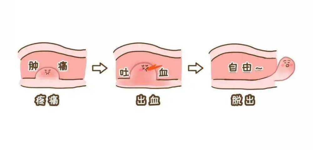 痔瘡症狀圖片為什麼有的痔瘡疼有的不疼