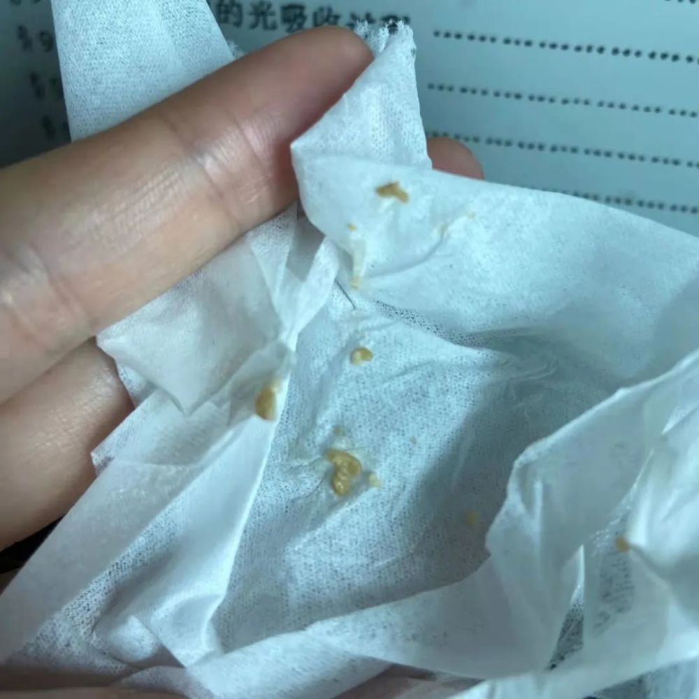 吐出臭臭的黄色颗粒这是我吃进去的玉米和椰子吗