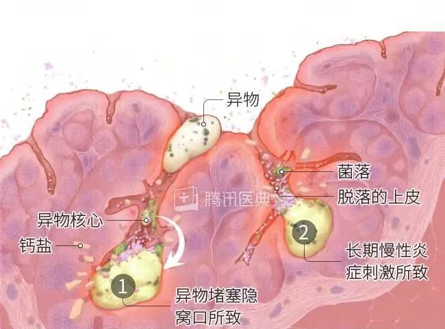 扁桃体结石形成的病理机制丨腾讯医典本文作者扁桃体结石的形成很有