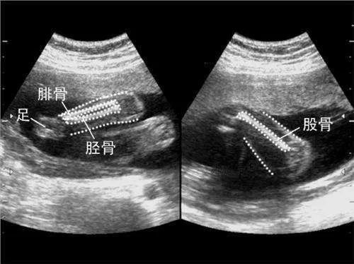 孕35周胎兒股骨長偏小腿短嗎4個原因要知道4招應對