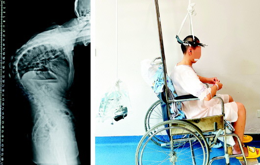 患上罕见病脊柱严重变形 "驼背女孩"矫正手术后"挺起脊梁"|脊柱|手术