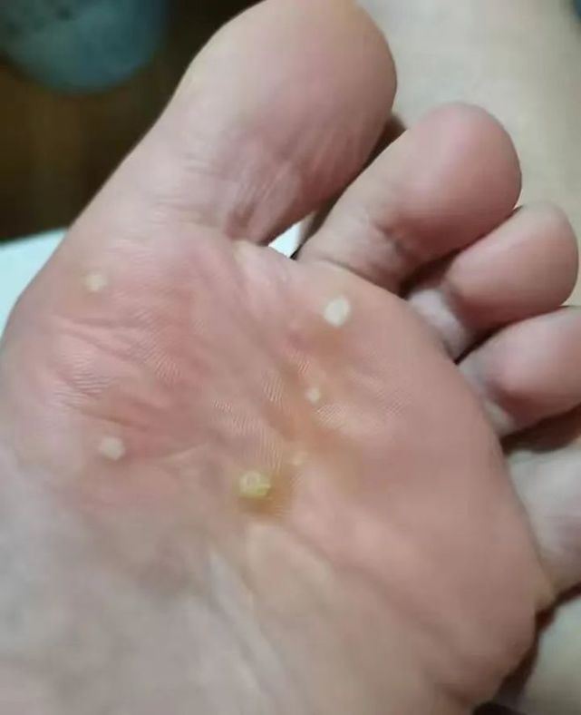 10岁男孩感染hpv引发跖疣如何挑选干净卫生的泳池